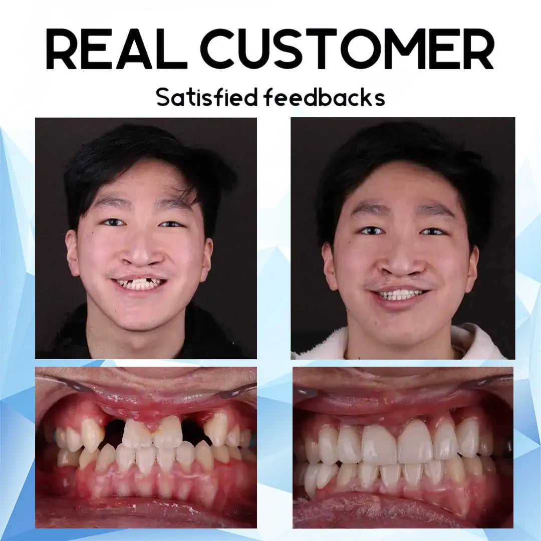 A naturally looking white smile without a dentist | PerfectSmile™
