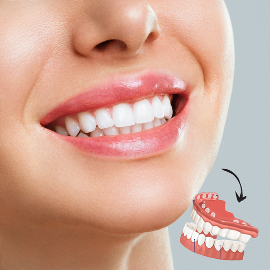 A naturally looking white smile without a dentist | PerfectSmile™