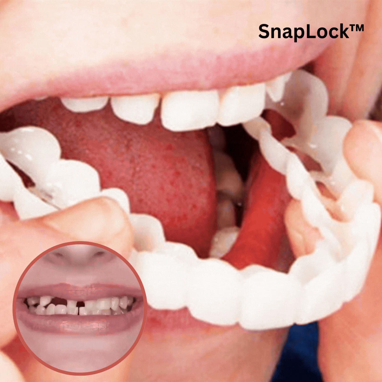 Get a radiant smile without the dentist | SnapLock™
