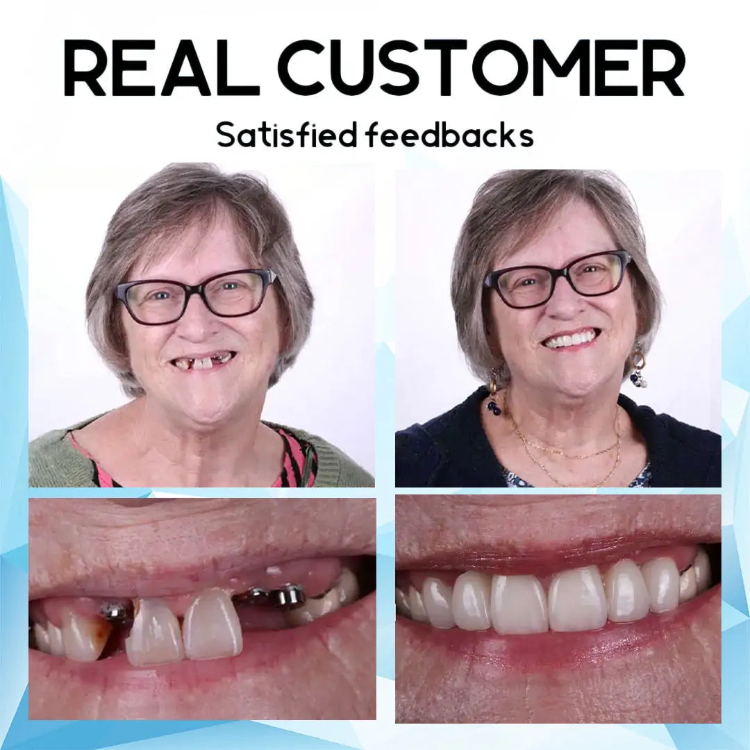 A naturally looking white smile without a dentist | PerfectSmile™